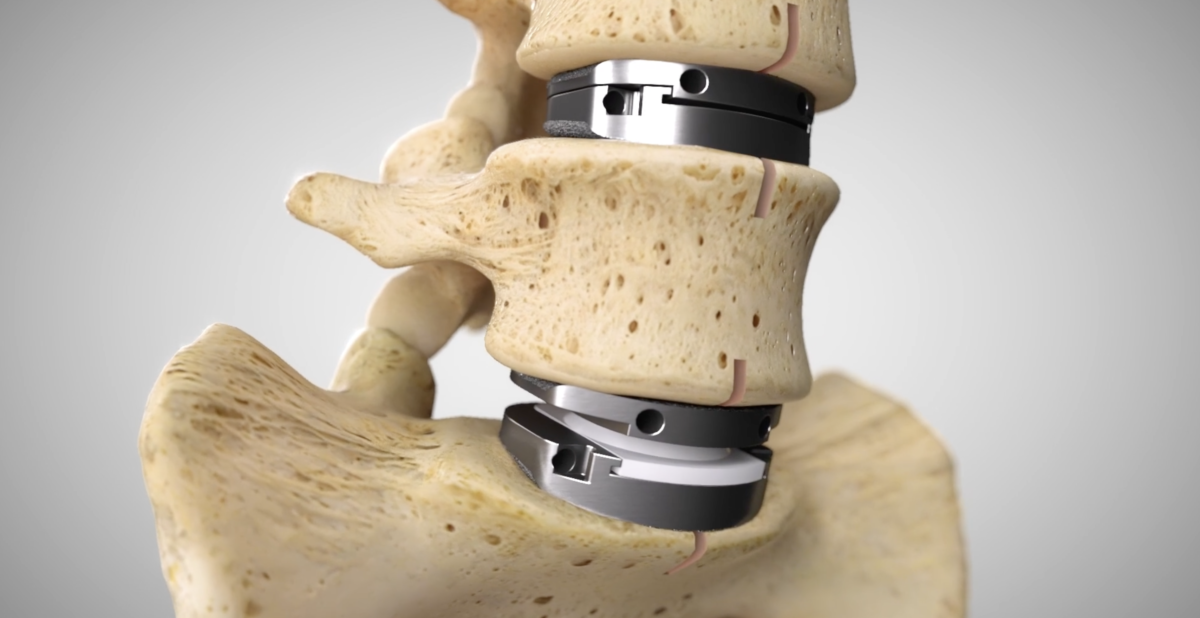 Lumbar artificial disc replacement San Antonio TX