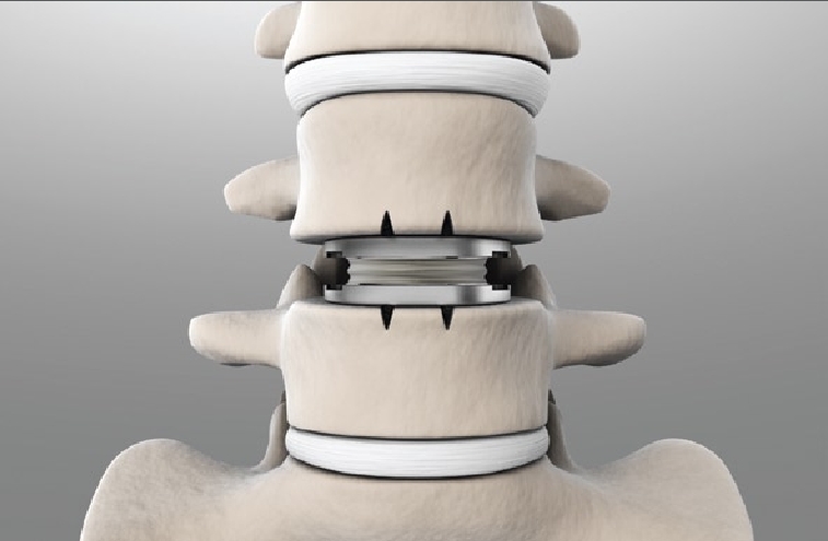 Surgeon for lumbar artificial disc in Victoria