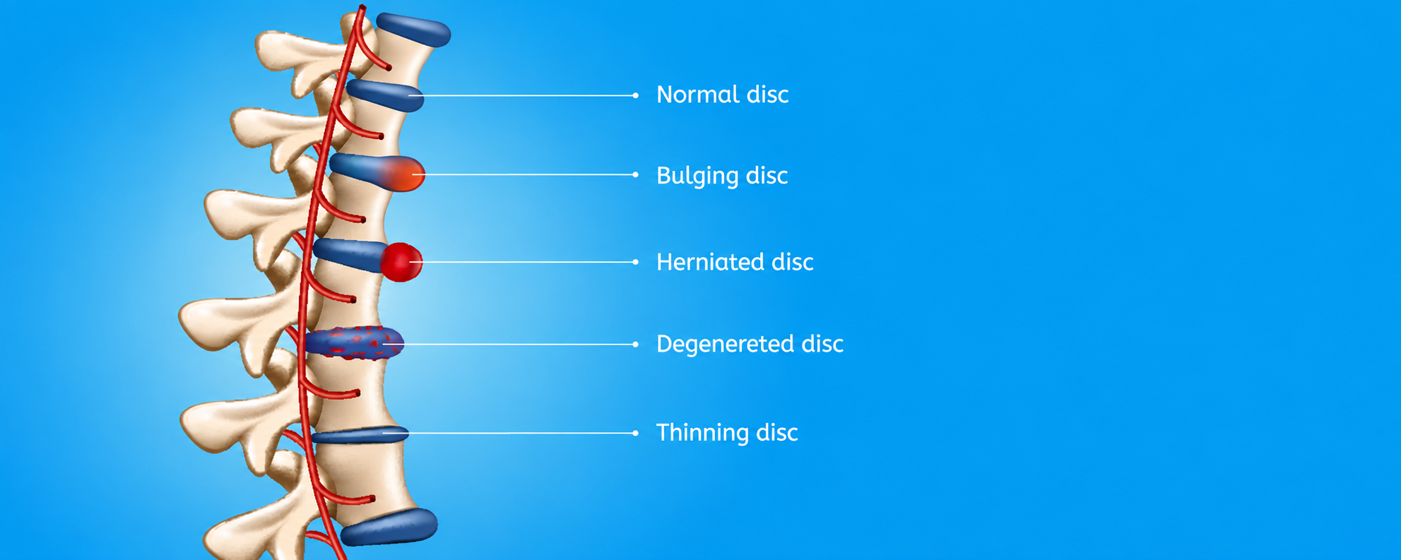 Herniated Disc Treatment in Boerne, TX with Dr. Osama Ahmed